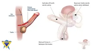 HOW TO USE Boston Scientific (AMS 700 CX) Inflatable Penile Prosthesis