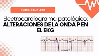 Alteraciones de la Onda P en el EKG: HIPERTROFIA AURICULAR DERECHA E IZQUIERDA