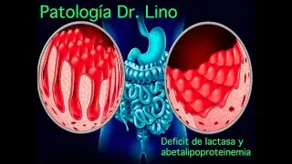 Anatomía patológica - Síndrome de Malabsorción - Deficiencia de lactasa y abetalipoproteinemia.
