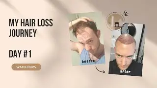 First Day After Hair Surgery At HLC Clinic