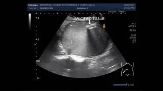 A large Gut-related Mass with calcified tissue in it.