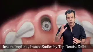 Top Dentist in Delhi Shares SECRET to PAINLESS Dental Implants