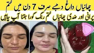 Remove Hyperpigmentation FAST | 100% Natural Home Remedy for All Skin Types