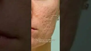 How to get rid of acne scars with Tretinoin | Acne scar Treatment #sristydutta #acnescars #shorts
