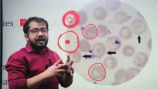 Copy of Poikilocytosis || Sickle cell || Echinocyte || Bite || Cell || Cabot Ring&nbsp;||&nbsp;Spherocytes