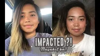 Wisdom tooth extraction and Healing Process! (Bvlog#15)