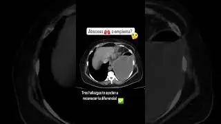 Cu&aacute;les son los 3 hallazgos en TC para hacer diagn&oacute;stico? #radiologia #torax #ct