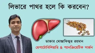 When to have surgery for liver stones | লিভার পাথর| Dr Mustafizur Rahman
