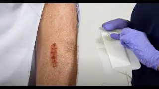 How to Apply ComforTech Dressings for MicroDoc
