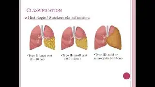 Case Presentation   CPAM Hemangini Zala