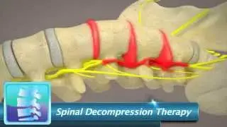 Spinal Decompression Therapy | Integrated Spinal Solutions - Reno Chiropracters