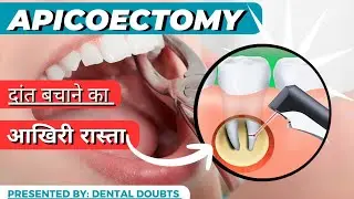 If RCT Failed ! Then Save Your Tooth With APICOECTOMY | #dentaldoubts #rootcanaltreatment #cavity