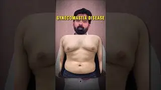 GYNECOMASTIA Treatment in Ayurveda | A to Z Ayurveda &ndash; G | Natural Hormone Balance Tips #ayurveda
