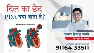 बच्चों के Heart में PDA से जुडी सटीक जानकारी एवम उसका ईलाज #PDA #PDADevice