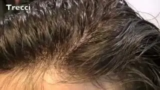 081 5990307 prezzi e costi protesi capelli veri Napoli, Caserta- calvizia