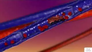 How Blood Clots Form