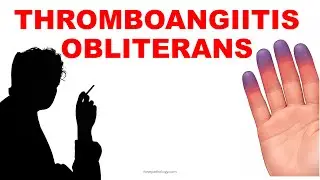 Облитерирующий тромбоангиит / Болезнь Бюргера | Патогенез и морфология | Васкулит &ndash; Часть 4
