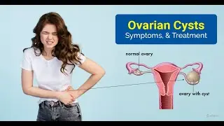Oveaian Cyst Treatment by TIENS products and Therapy