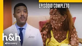 🔴 Episodio completo | Especialistas em Tumores - S1 Ep1 | H&H Brasil