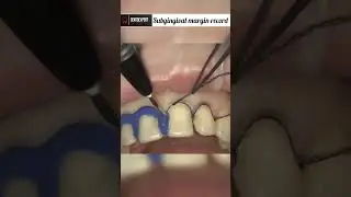 Subgingival Margin Record | Gingival Retraction Cord Removal #shorts #dentist #impression #viral