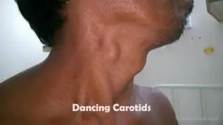 Dancing carotids   Corrigan&rsquo;s sign