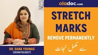How To Get Rid of Stretch Marks Urdu Hindi- Stretch Marks Causes Treatment - Stretch Marks Ka Ilaj