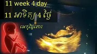 ពិនិត្យអេកូផ្ទៃពោះ 11អាទិត្យ 4ថ្ងៃ pregnancy ultrasound 11 week 4 day by Dr.Bun laysophea