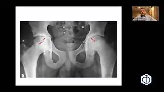Slipped Capital Femoral Epiphysis, SCFE  Prof  Hisham Abdel Ghani, LRS PD Academy, B2B