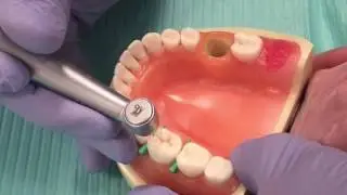 class II preparation