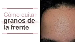 C&oacute;mo quitar los granos de la frente l Dra. Mar&iacute;a Clara Mej&iacute;a