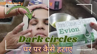How to Remove dark circles under eyes at home | Eye ke niche kalapan kaise dur kare