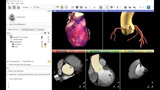 Coronary vessel segmentation on cardiac CT images