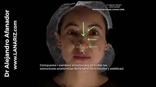 Rinoplastia Estructurada & compuesta
