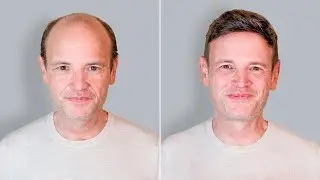 Vom Haarkranz zum vollen Haar – Haarsystem bei kompletter Glatze | Frankfurt
