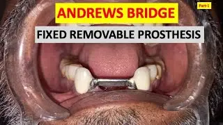 PART-1// ANDREW'S BRIDGE// Fixed Removable Prosthesis// Prosthodontics// Dental Education// RPD//PFM