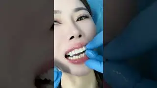 how to place veneers #veneers #veneer #viral #kpkvines #peshawarzalmi #short
