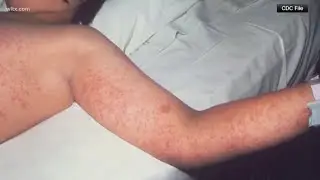 Measles outbreak continues to grow in South Carolina