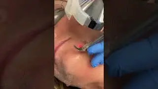Sciton Profractional Laser Treatment for the face. Seriously Skin Cleveland, Ohio.