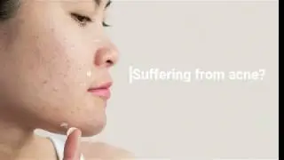 Acne Treatment: Gold Photothermal Therapy (Gold PTT)