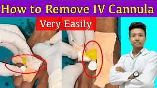 IV Cannula Removal Procedure | How to Remove an IV Cannula | Health Sector