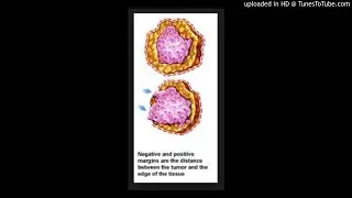 Positive Margins in Breast Cancer
