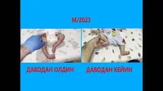 Tugʼma maymoqlik tuzaladigan nuqson!!! / Врожденная кослапость &ndash; излечимая болезнь!!!