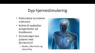 Digitalt fagmøte om dyp hjernestimulering