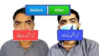 Squint (Bhengapan) Correction Surgery Result & Advice | Urdu Hindi
