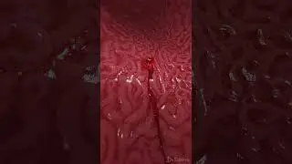 Bleeding gastric ulcer 3d animation  #anatomy #meded