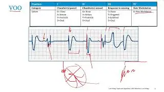 Pacemaker Mode Selection and 12 Lead ECG Interpretation of STEMI  - Port Harcourt Pacing