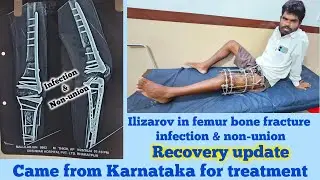 Femur and tibia bone fracture infection non-union bone Patient came from karnataka #ilizarovsurgery