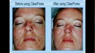 Dramatic ClearPores Before and After Photos: ClearPores Is The Top Product For Serious Acne!