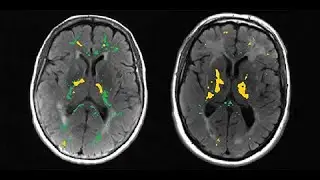Microglial activation and blood&ndash;brain barrier permeability in cerebral small vessel disease