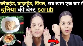 इस तरह करें scurb whitehead, blackhead, open pores ,सब गायब First use में | DIY Scrub